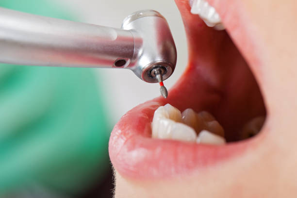 Best Emergency Dentist for Lost Fillings or Crowns in , UT